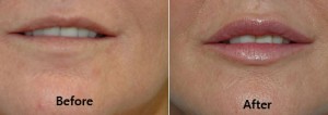 Juvederm Lip Injections