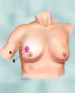 lumpectomy_tcm8-326760