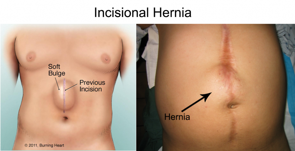 Incisional hernia los angeles