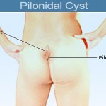 Pilonidal Cyst